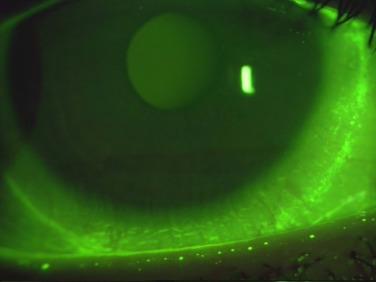 Fig. 11.7, Arcuate band of fluorescein staining corresponding to the edge of an extended-wear silicone hydrogel contact lens.