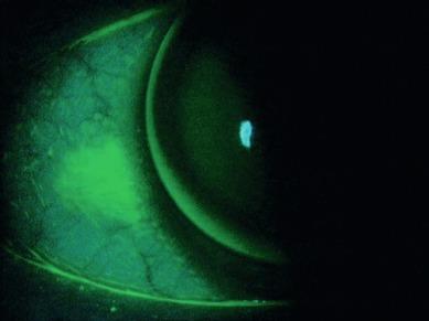 Fig. 11.8, Arcuate band of fluorescein staining corresponding to the edge of a rigid lens, which was bound to the eye upon awakening after overnight lens wear.