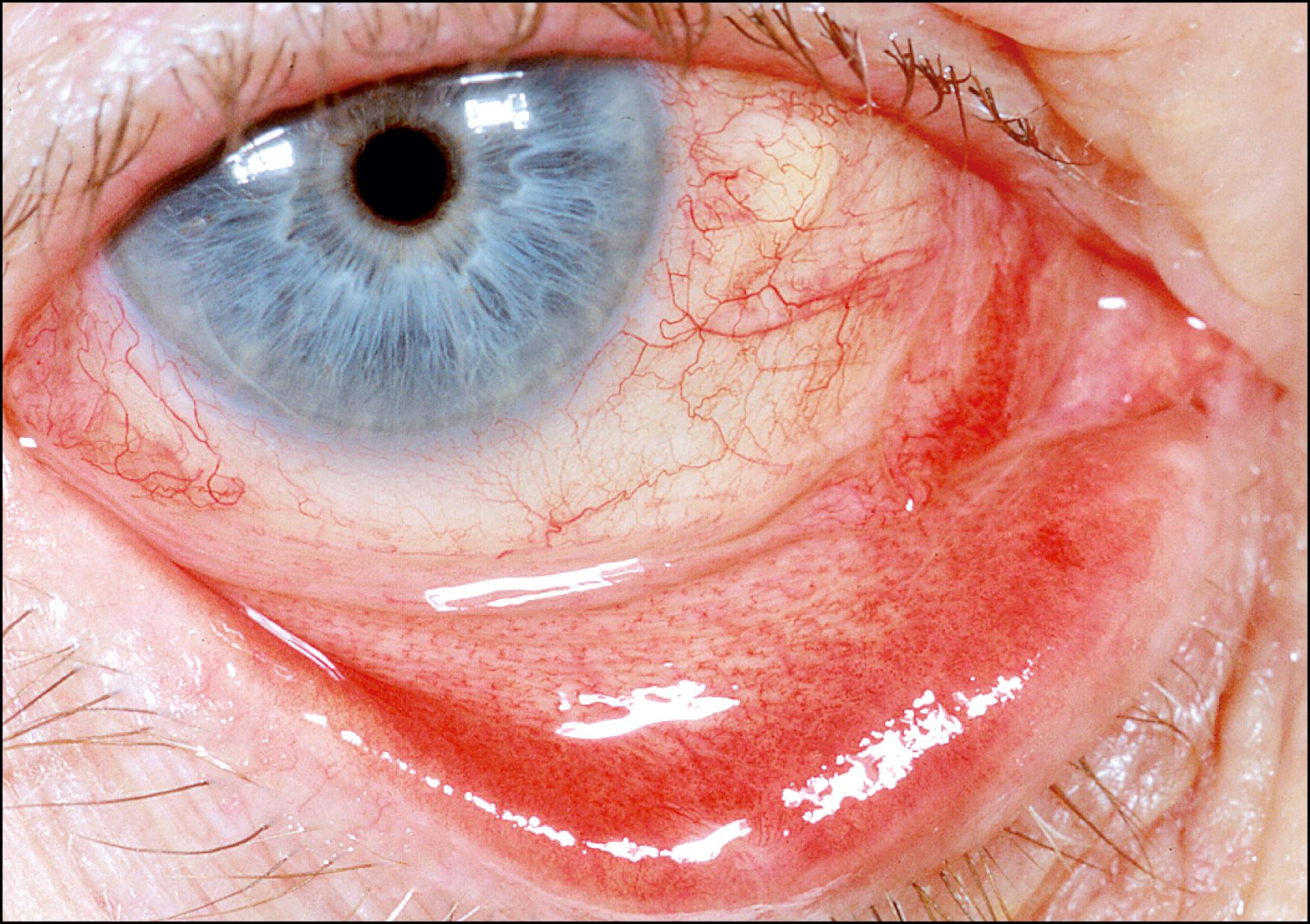 Fig. 36.3, Fine papillary conjunctivitis. Note the fibrovascular core in which the blood vessels arborize on reaching the surface.