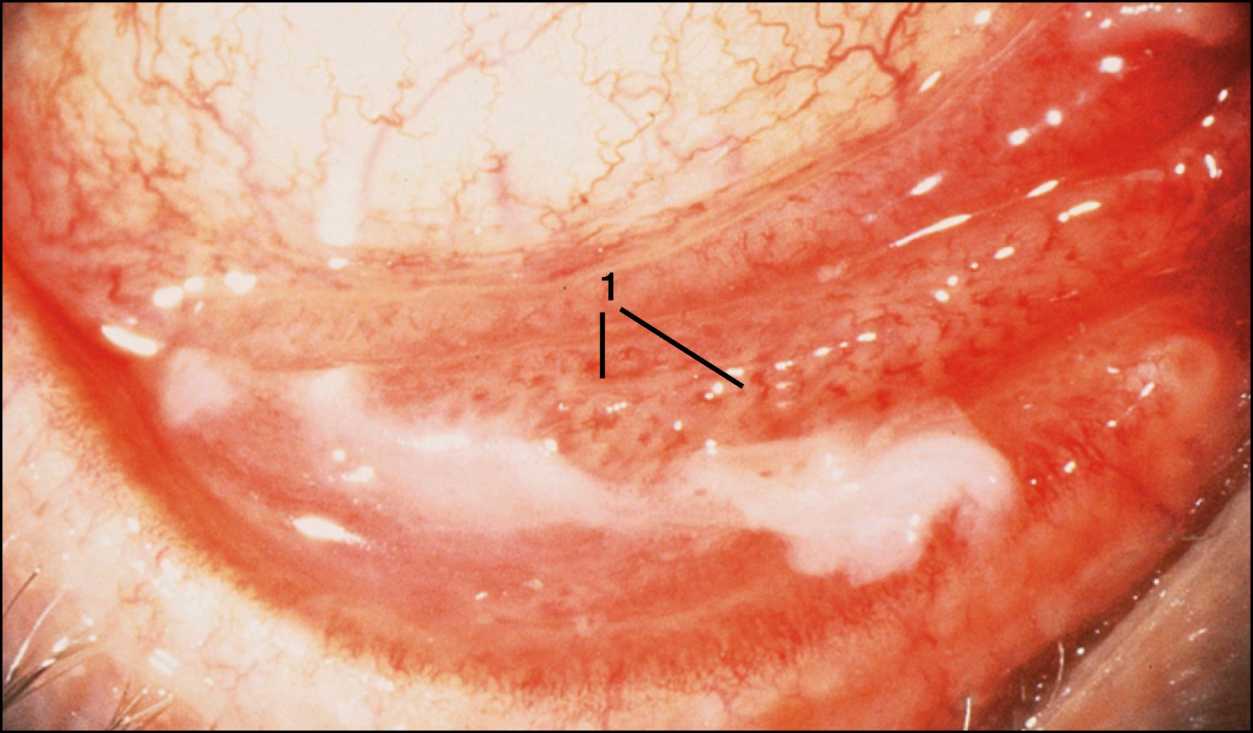 Fig. 36.5, Membranous conjunctivitis secondary to epidemic keratoconjunctivitis. The pseudomembrane is composed of fibrin and polymorphonuclear leukocytes obscuring much detail of the palpebral conjunctiva. Petechial hemorrhages (1) can be seen.