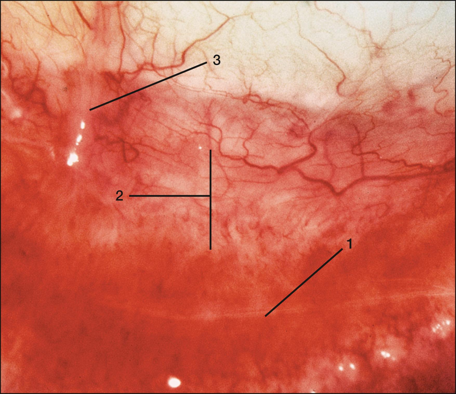 Fig. 36.6, Cicatrizing conjunctivitis secondary to mucous membrane pemphigoid. Note the fine, lacy subepithelial fibrosis (1) , foreshortening of the inferior fornix (2) , and symblepharon formation (3) .