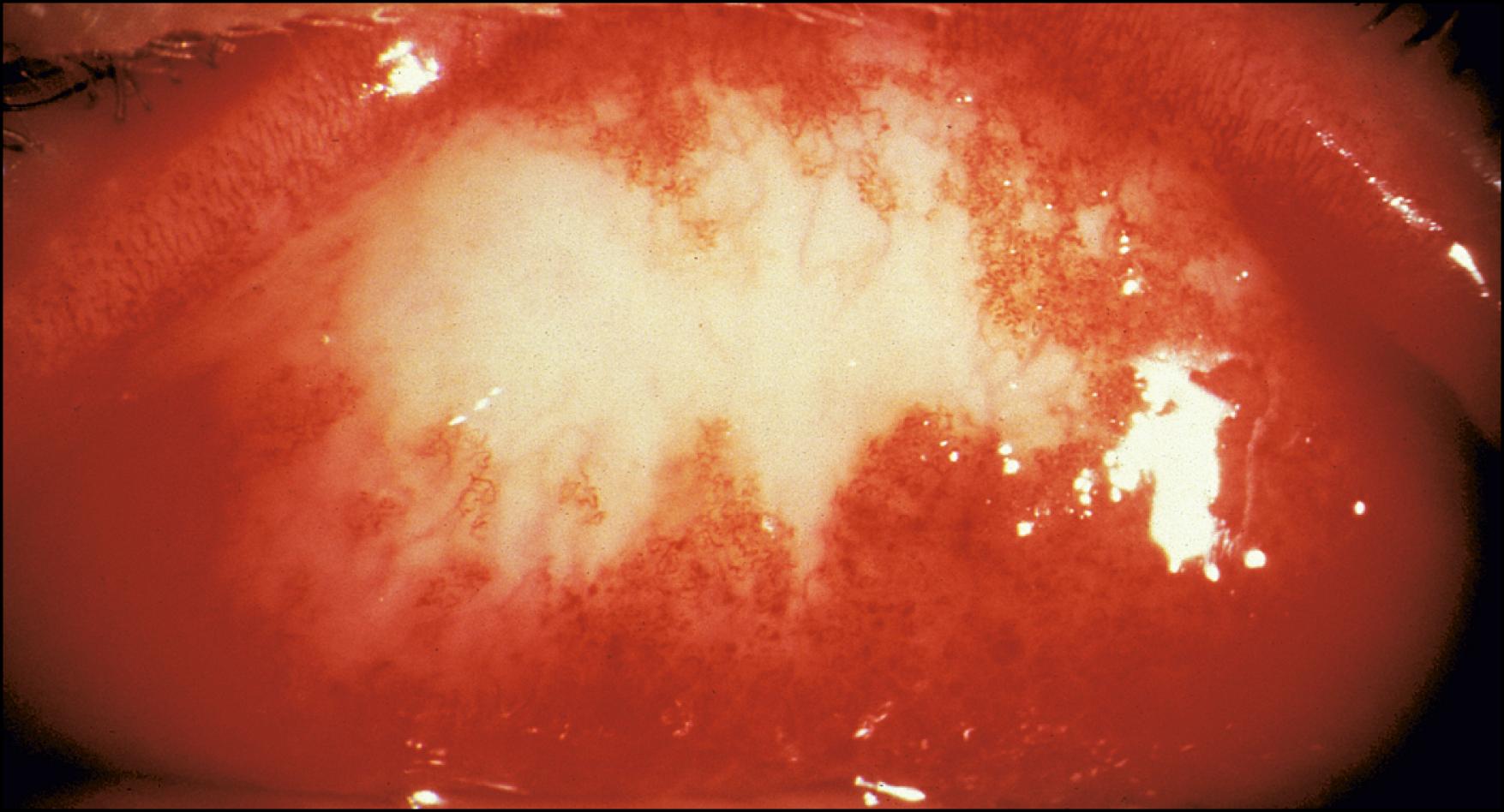 Fig. 36.7, Granulomatous conjunctivitis secondary to parinaud oculoglandular syndrome. Conjunctival granulomas always affect the conjunctival stroma.