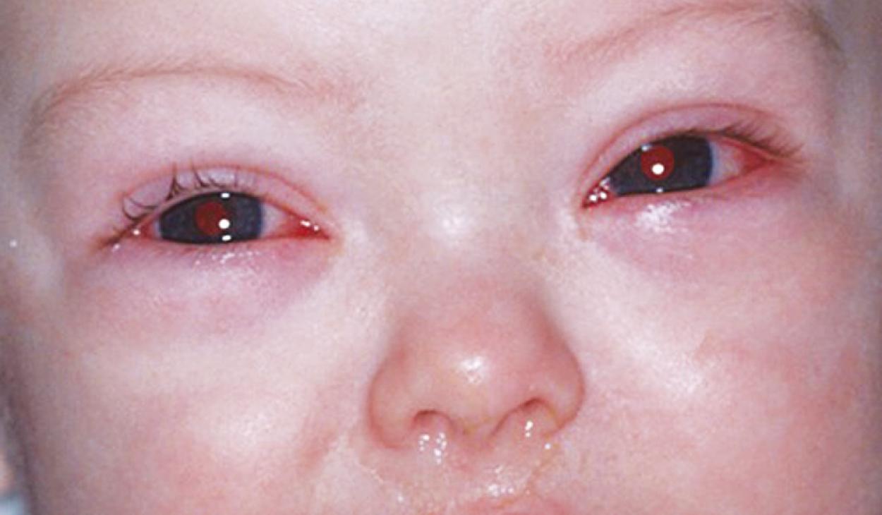 FIGURE 80.1, Bilateral conjunctivitis due to adenovirus.