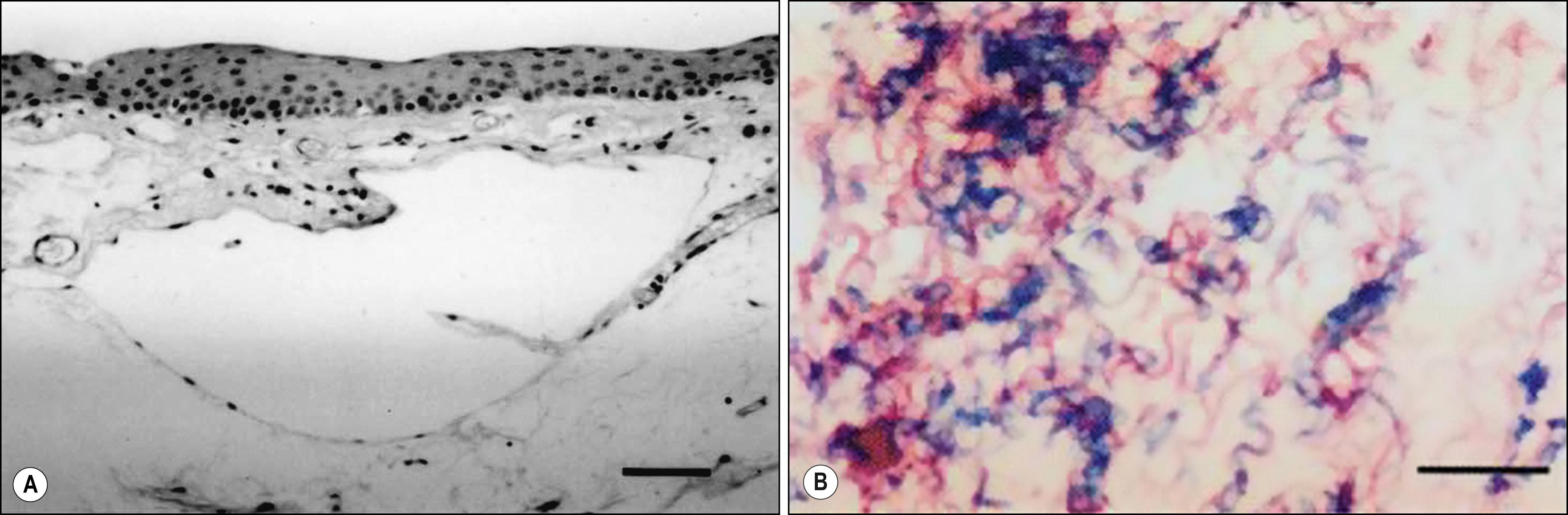 Fig. 50.2, Histologic sections of patients who had conjunctival resection for conjunctivochalasis. ( A ) Hematoxylin-eosin staining showing normal epithelium with large lymphangiectasia and negligible inflammation. ( B ) Elastica van Gieson staining showing fragmentation of elastic fibers and sparsely assembled collagen fibers.