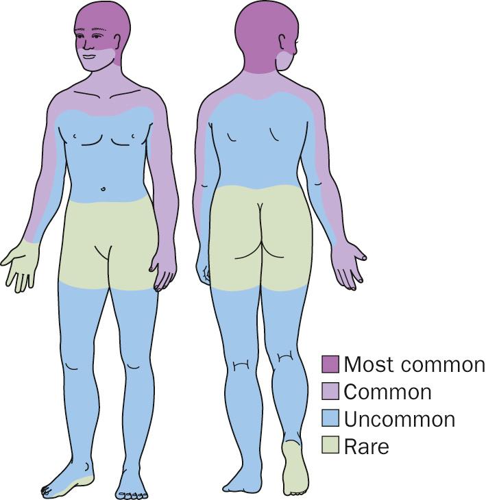 Fig. 14.1, Lupus erythematosus distribution diagram.