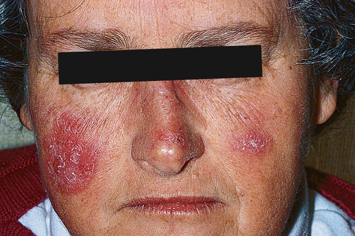 Fig. 14.11, Chronic cutaneous lupus. Red plaques and scale are seen; scarring has not yet occurred.