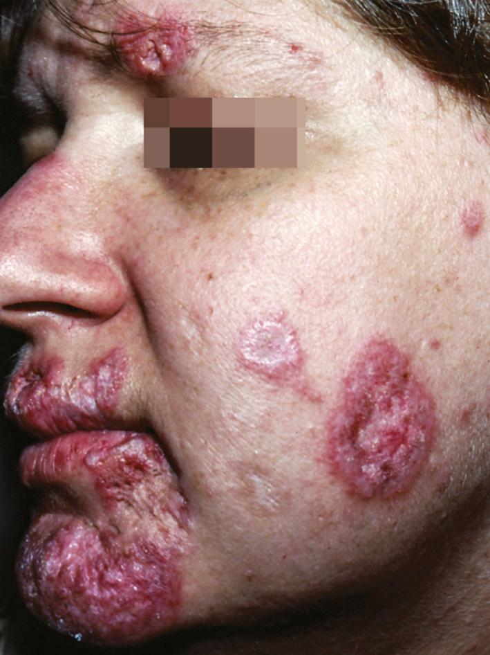 Fig. 14.12, Classical discoid lupus lesions showing atrophic scarring in the center, whereas surrounding the scarred areas remain actively inflamed.