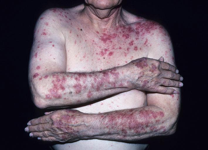 Fig. 14.14, Papulosquamous rounded patches are scattered in a photo distribution in this patient with subacute cutaneous lupus. Drug-induced subacute cutaneous lupus erythematosus should always be considered.