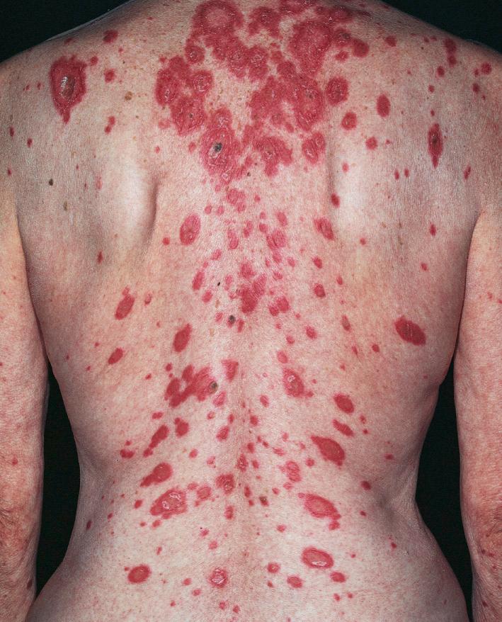 Fig. 14.15, Annular and polycyclic erythematous plaques of subacute cutaneous lupus erythematosus. The border of lesions is scaly. Lesions are rare below the waist. Biopsy is helpful in distinguishing this eruption from psoriasis or cutaneous T-cell lymphoma.