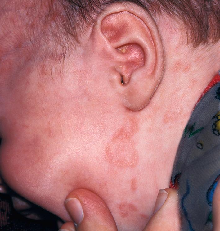 Fig. 14.16, Neonatal lupus. Annular erythematous plaques with a slight scale usually appear on the head slightly after birth. Sun-exposed areas of the arms and trunk may also be involved. Telangiectasia is often prominent. Skin lesions resolve with time.