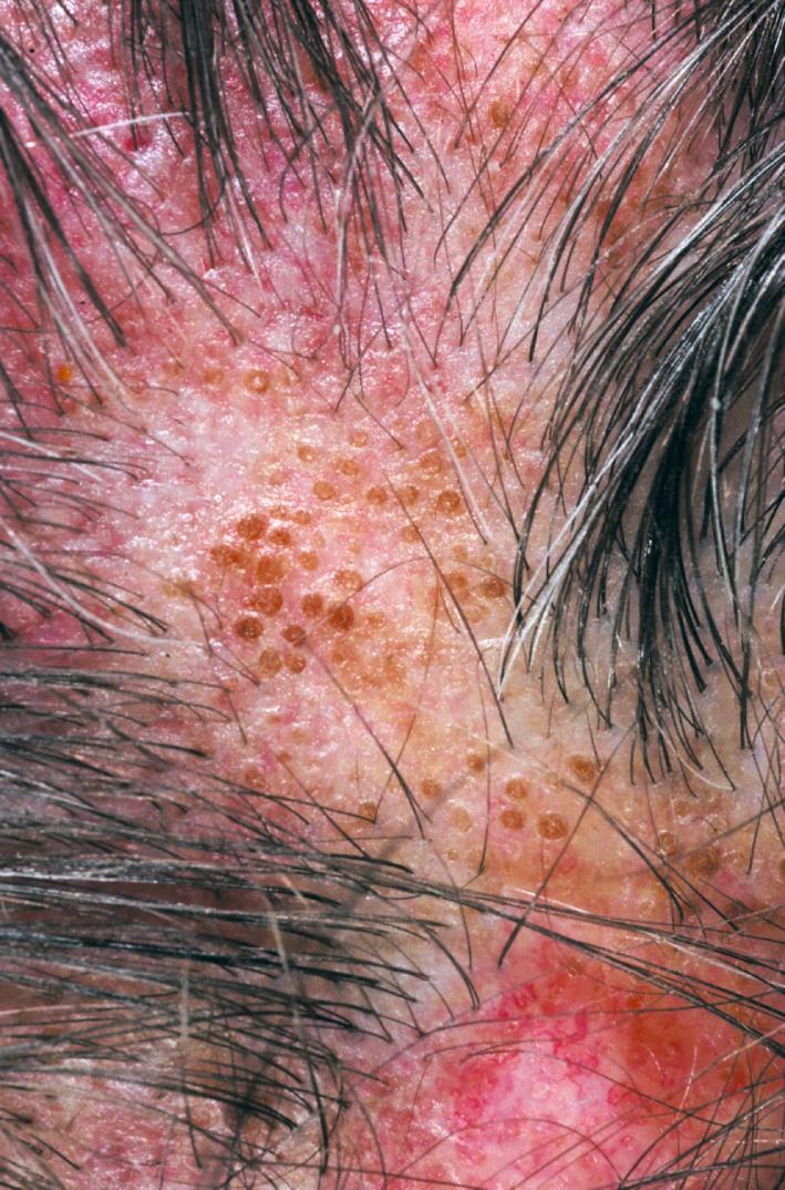 Fig. 14.2, Chronic cutaneous lupus (discoid lupus) of the scalp. Hyperkeratosis and inflammation occur. Older lesions scar and show follicular plugs. Keratin accumulates and dilates the follicular orifice causing the follicular plugging.