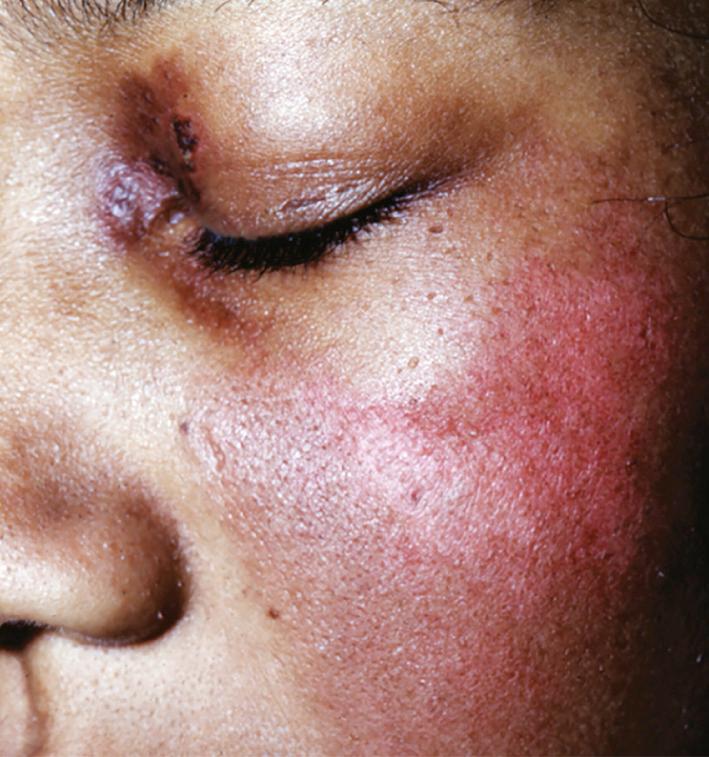 Fig. 14.3, Lupus erythematosus. Erythematous patch on the malar region most typically spares the nasolabial fold and nose. Malar rash is specific for acute cutaneous lupus erythematous and is present in 20% to 60% of patients with lupus.