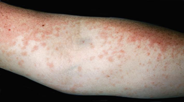 Fig. 14.5, Erythematous coalescing macules scattered on the forearm of a patient with systemic lupus erythematosus.