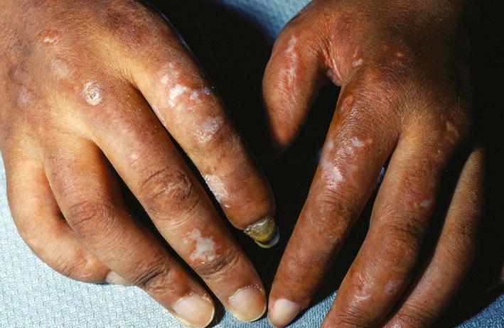 Fig. 14.6, Multiple atrophic macules on the dorsum of the hands in a patient with generalized discoid lupus erythematosus. The lesions of chronic cutaneous lupus are scarring.