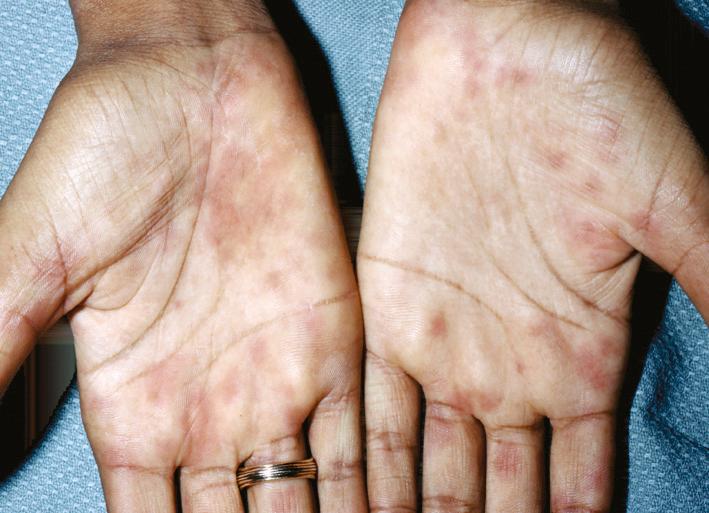 Fig. 14.7, Violaceous macules scattered on the palms of this patient with systemic lupus erythematosus.