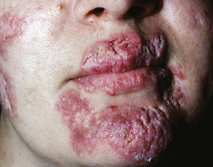 Fig. 14.8, Round, erythematous plaques with depressed scarred areas surround the mouth in this patient with discoid lupus. Treatment is essential to prevent the scaring from these lesions.