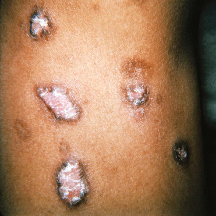 Fig. 14.9, Plaques of chronic cutaneous lupus, which are both erythematous and hyperpigmented, are oval with central scaling. Biopsy confirms the diagnosis.