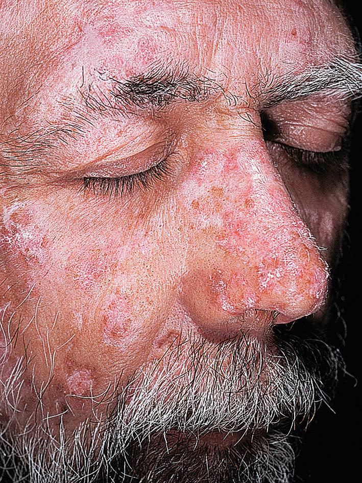 Fig. 14.10, Chronic cutaneous lupus. The face is the most commonly affected area. Epidermal atrophy occurs early and gives the surface either a smooth, white appearance or a wrinkled appearance.