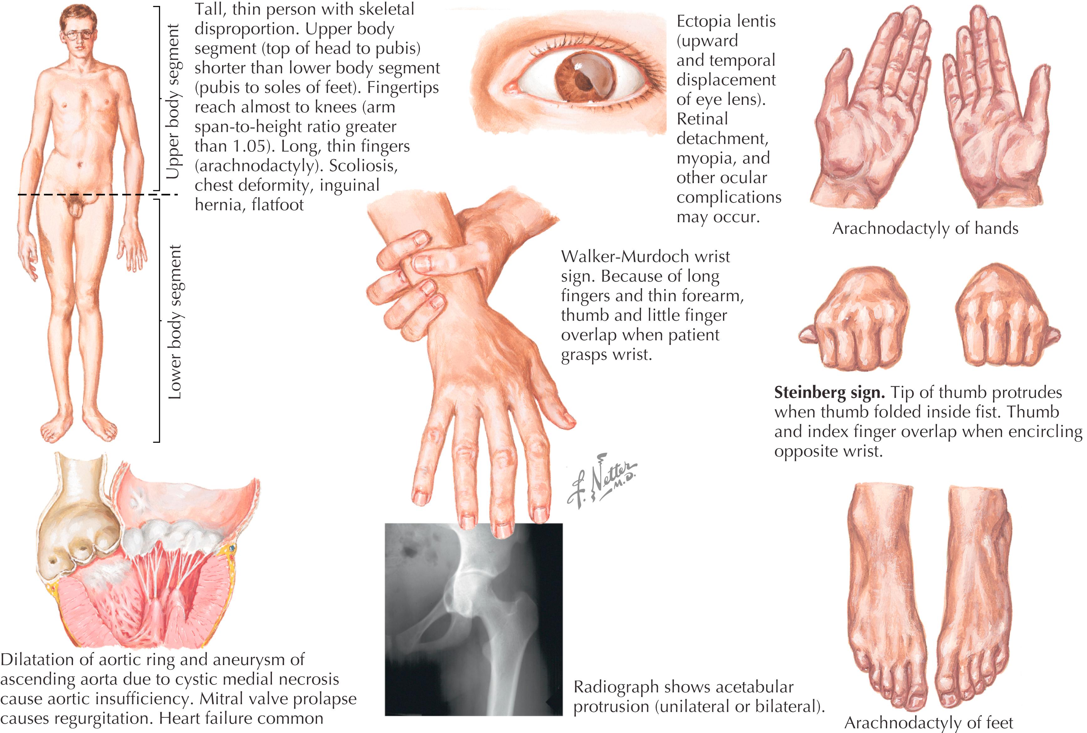 Figure 41.1, Characteristics of Marfan syndrome.