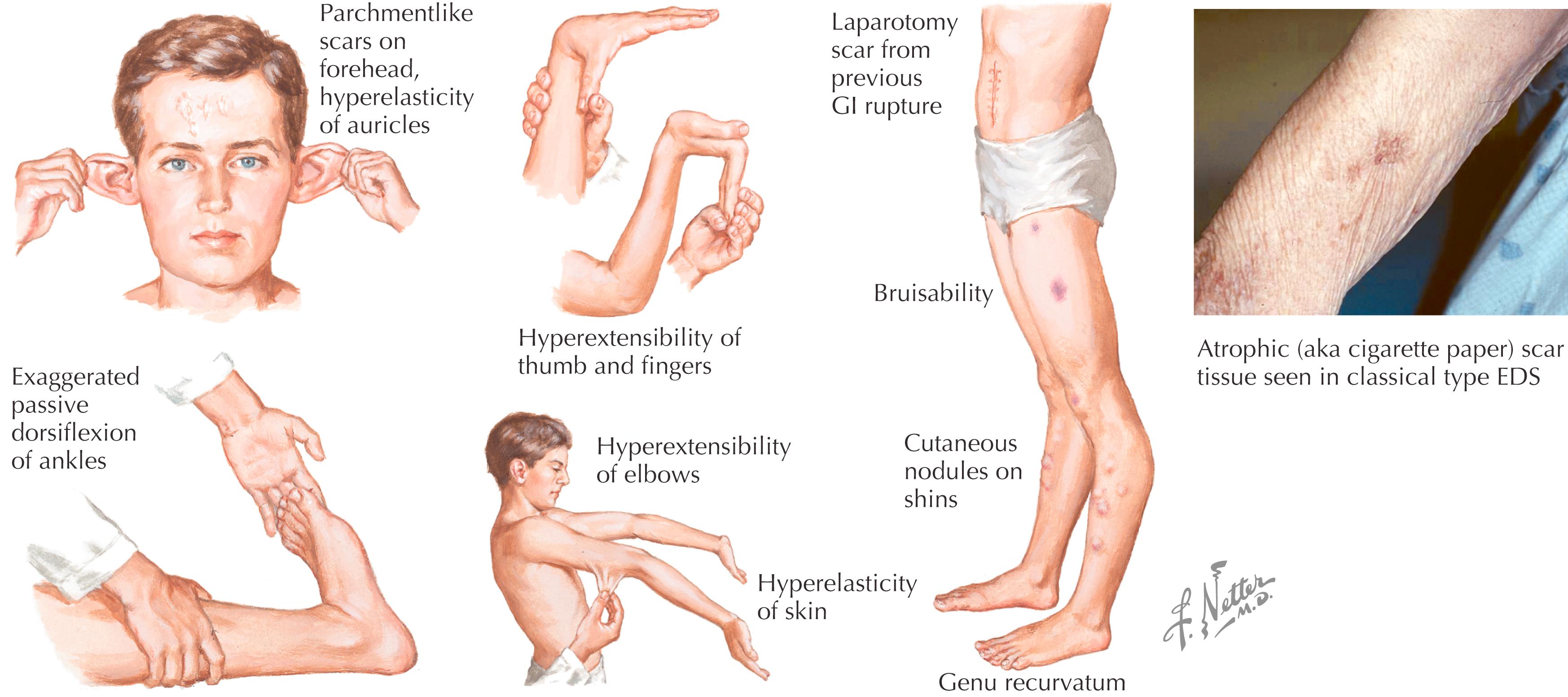 Figure 41.2, Characteristics of Ehlers–Danlos syndrome.