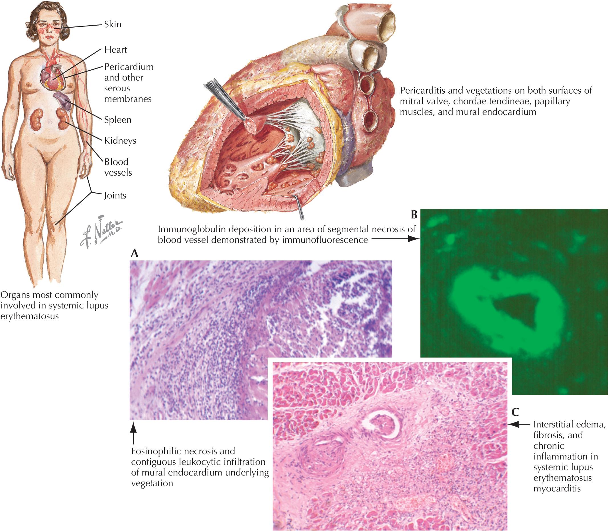 FIG 67.1, Lupus Erythematosus.