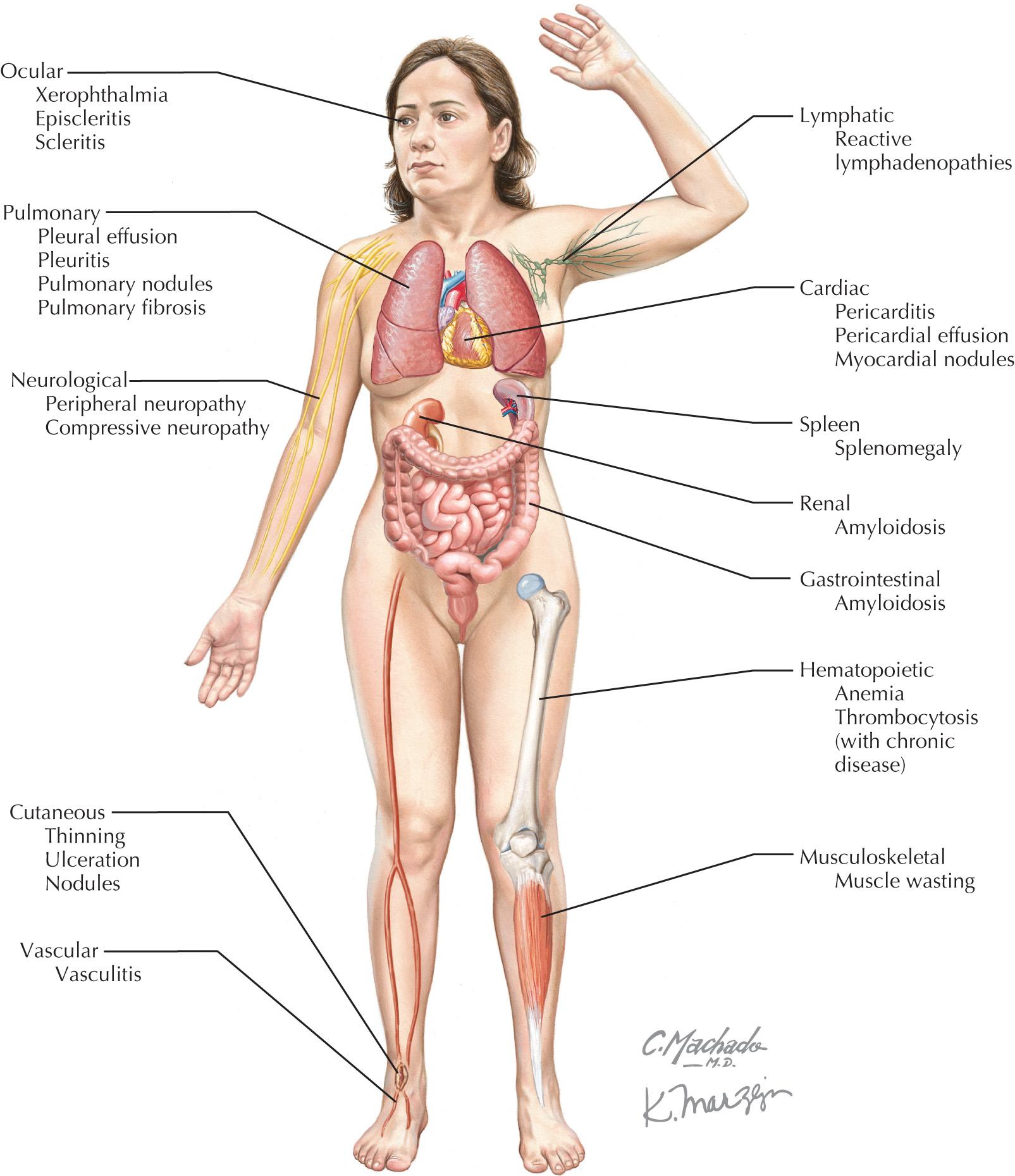 FIG 67.2, Systemic Manifestations of Rheumatoid Arthritis.