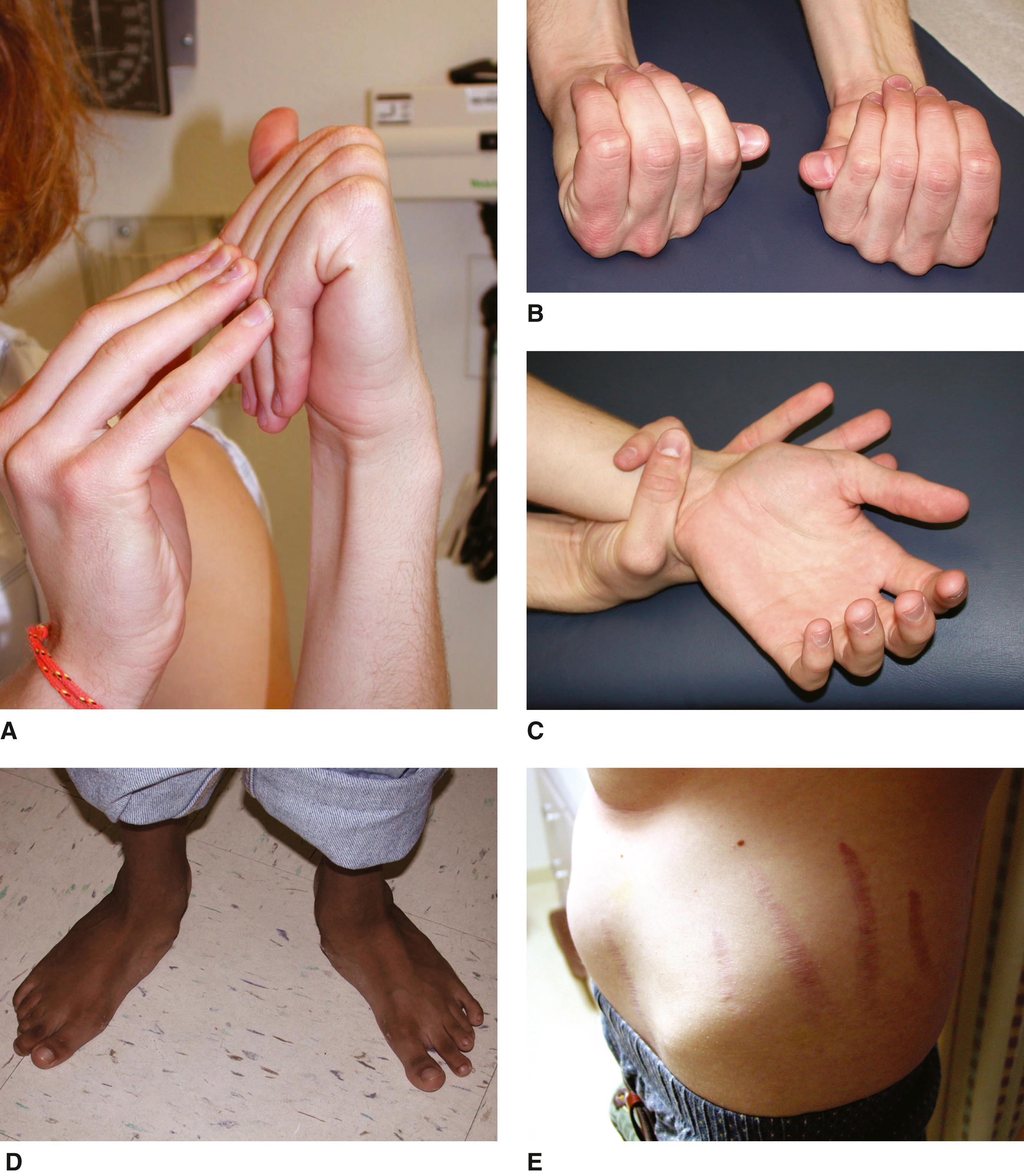 FIGURE 2, Note the joint laxity (A), Steinberg thumb sign (B), ability to join thumb and fifth finger around the wrist (Walker-Murdoch sign) (C), pes planus (D), and striae over hips and back (E).