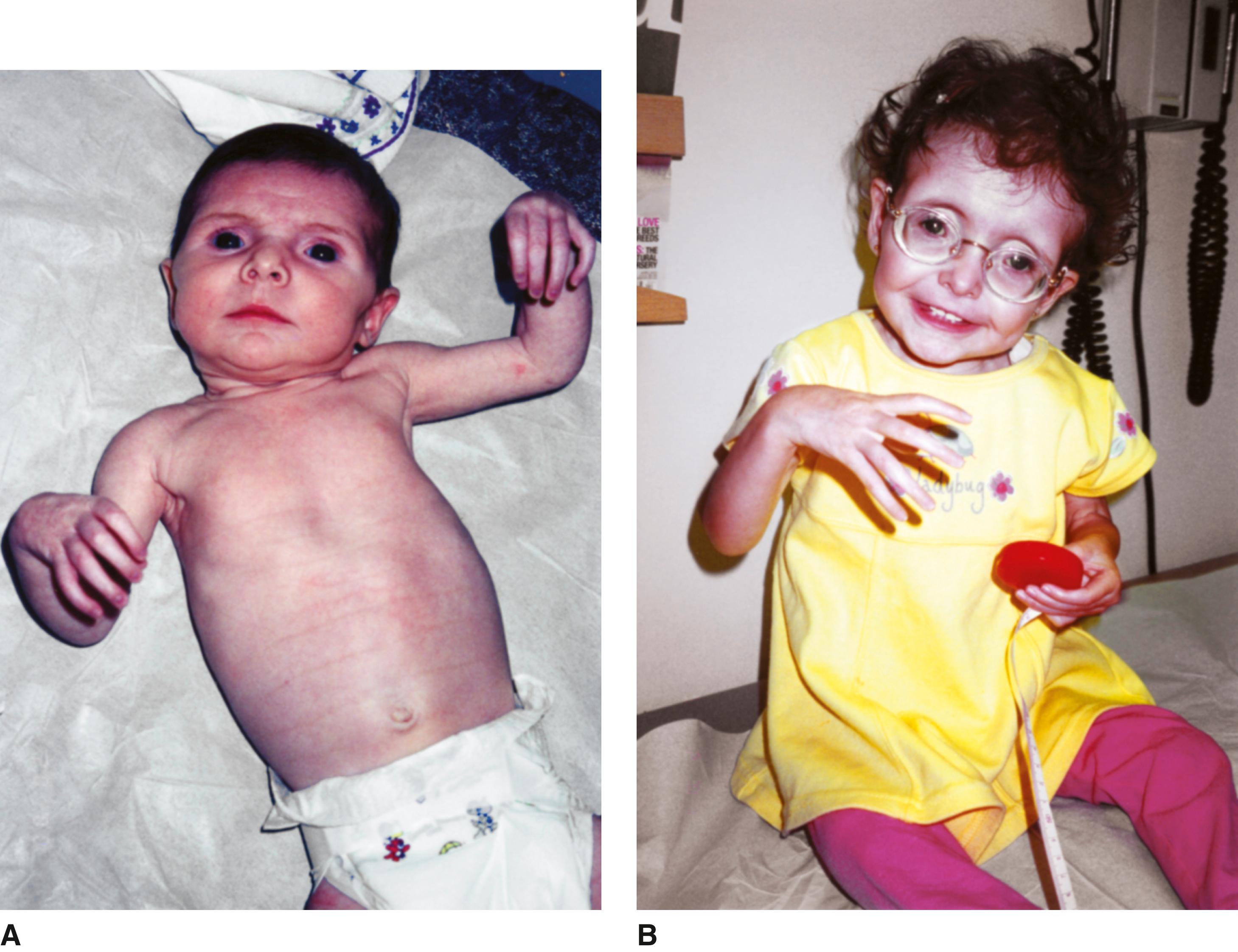 FIGURE 3, A and B, Child with neonatal form of Marfan syndrome.