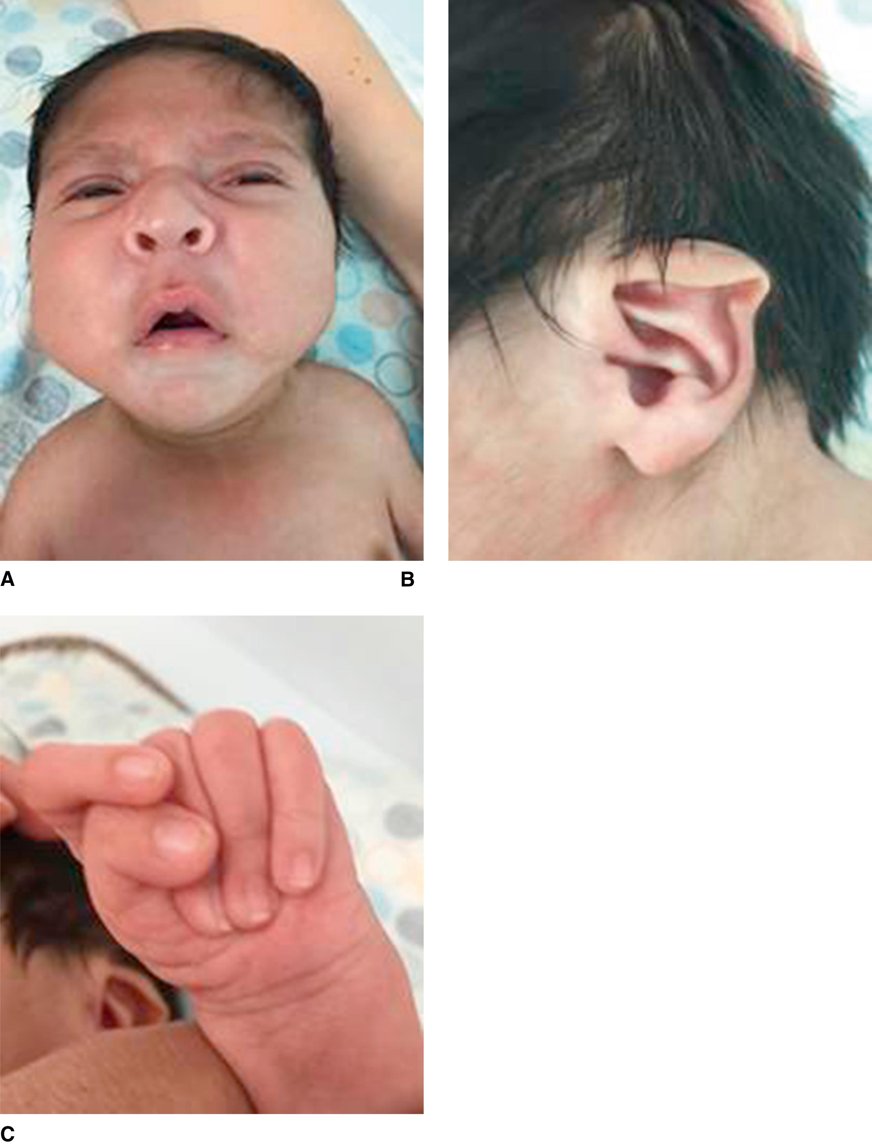FIGURE 1, A 1-month-old boy with Beals contractural arachnodactyly syndrome showing narrow palate, retrognathia, typical “crumpled ear,” and long fingers with characteristic camptodactyly and with ulnar deviation of thumb and second fingers causing overlap.