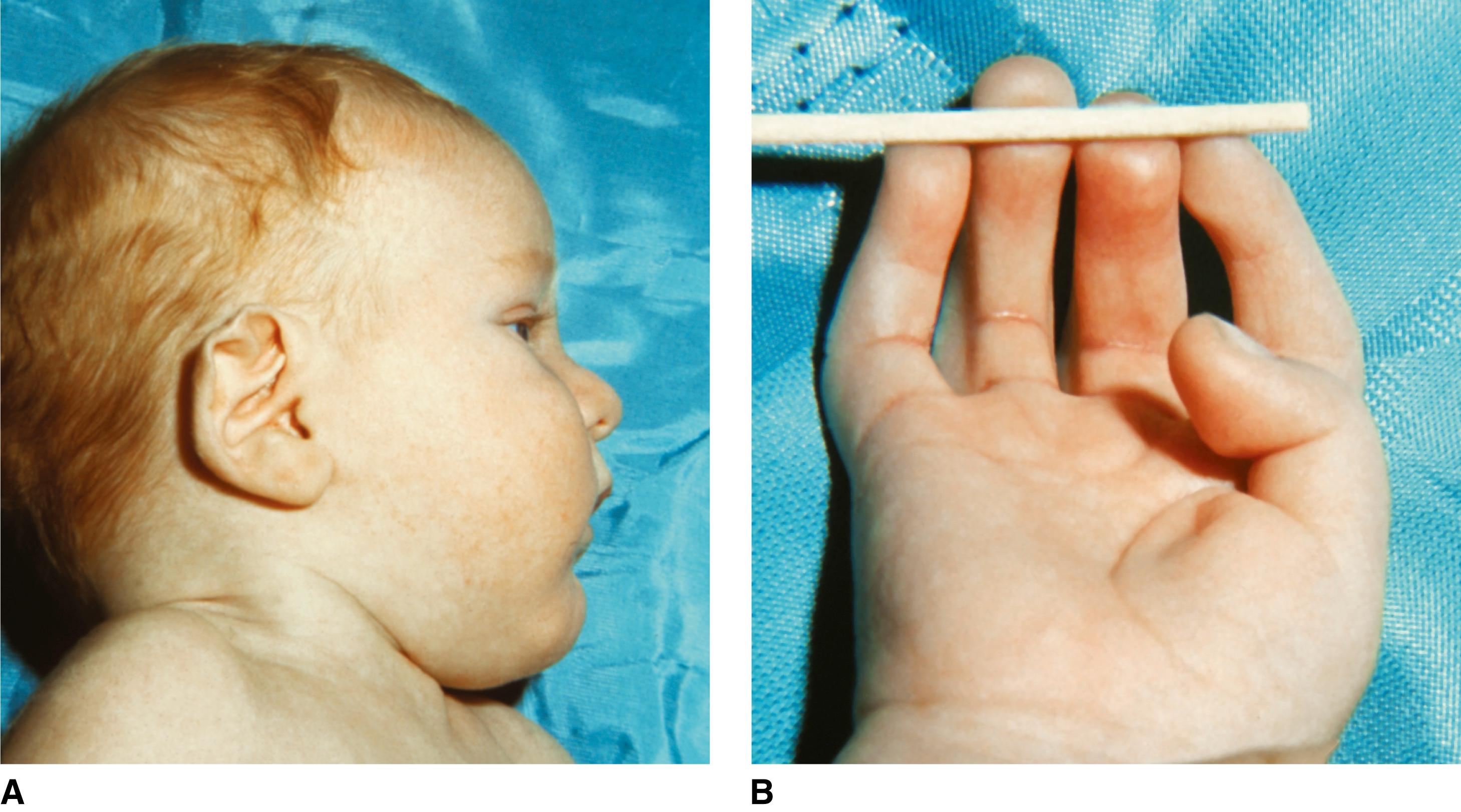 FIGURE 2, Beals syndrome.
