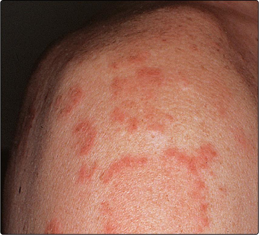 Fig. 45.3, Subacute cutaneous lupus erythematosus.