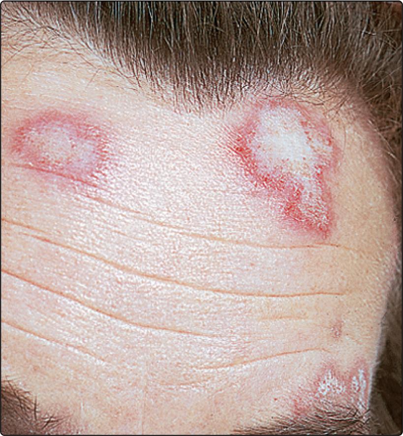 Fig. 45.4, Discoid LE on the forehead.