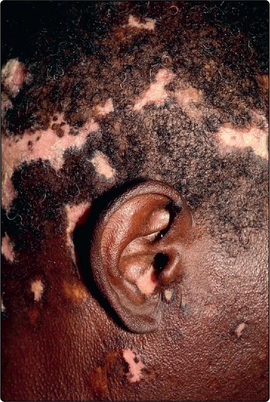 Fig. 45.5, Discoid lupus erythematosus of the scalp, producing scarring and hypopigmentation