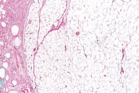 Fig. 35.1, Lipoma: low-power view showing a circumscribed encapsulated tumor composed of mature adipocytes.