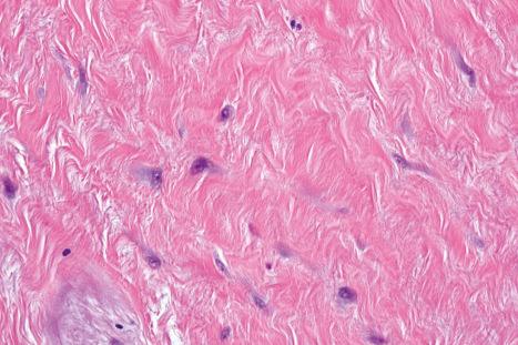 Fig. 35.103, Desmoplastic fibroblastoma: the tumor cells are fusiform or stellate. Mitotic figures are absent.