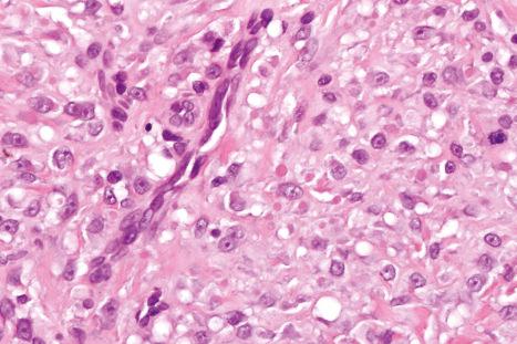 Fig. 35.106, Inclusion body fibromatosis: in this example, there are numerous inclusions.