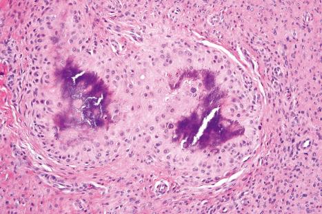 Fig. 35.108, Calcifying aponeurotic fibroma: in this section, there is chondroid metaplasia and there is focal basophilic calcification.