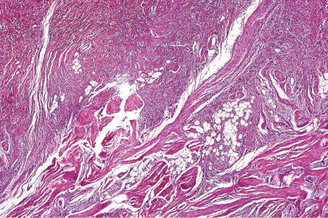 Fig. 35.114, Fibrous hamartoma of infancy: the tumor comprises mature fat, fibrous tissue, myofibroblastic elements, and circumscribed aggregates of undifferentiated mesenchymal cells.