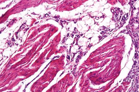 Fig. 35.115, Fibrous hamartoma of infancy: note the fascicles of myofibroblasts.