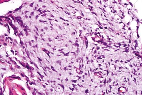 Fig. 35.116, Fibrous hamartoma of infancy: the primitive foci are composed of myxoid tissue containing small cells with round or oval vesicular nuclei.