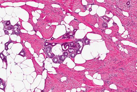 Fig. 35.118, Fibroblastic connective tissue nevus: somewhat hyalinized collagen, bundles of bland fibroblasts, and mature adipocytes.