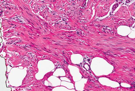 Fig. 35.119, Fibroblastic connective tissue nevus: high-power view highlighting fibroblasts and adipocytes.