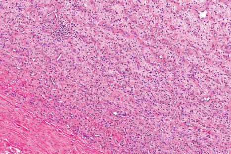 Fig. 35.120, Angiofibroma of soft tissue: a combination of short spindle-shaped cells and small vascular channels.