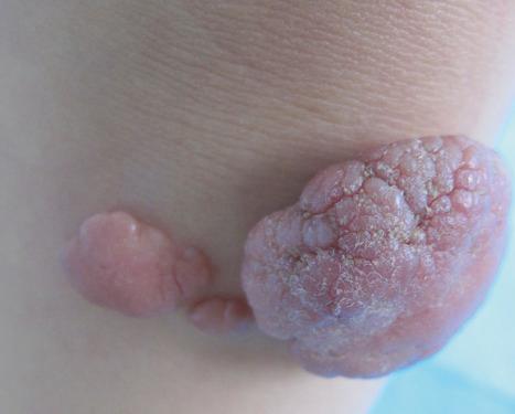 Fig. 35.12, Nevus lipomatosus superficialis: in this patient there are multiple papules and nodules.