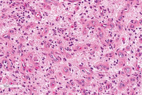 Fig. 35.121, Angiofibroma of soft tissue: abundant myxoid stroma.