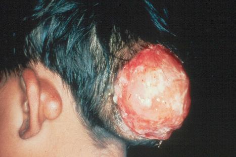 Fig. 35.122, Juvenile hyaline fibromatosis: there is a large circumscribed ulcerating mass. A smaller lesion is also present behind the left ear.