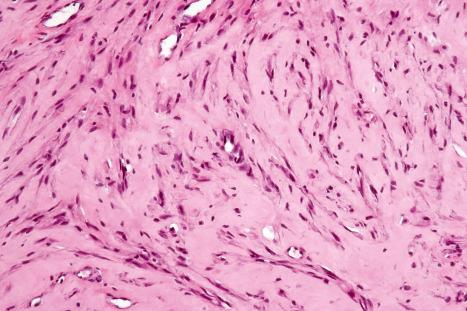 Fig. 35.124, Juvenile hyaline fibromatosis: other areas may be more cellular.