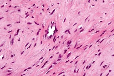 Fig. 35.125, Juvenile hyaline fibromatosis: the spindle cells are bland with hyperchromatic nuclei.