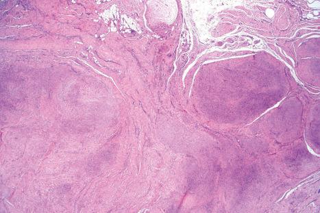 Fig. 35.126, Palmar fibromatosis: scanning view showing multiple nodules of hypercellular tissue with admixed hyalinized collagen.