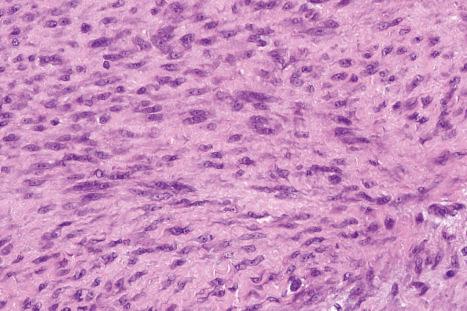 Fig. 35.127, Palmar fibromatosis: the lesion is composed of spindled cells with elongated vesicular nuclei containing small central nucleoli. Occasional normal mitotic figures are typical in early lesions.